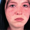 Free Educational Teleconference on Childhood Lupus