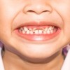 Las Bebidas sin Azúcar También Pueden Dañar los Dientes