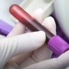 High Blood Sugar Might Raise Risk of Complications After a Heart Attack or Stroke