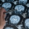 Stroke Hospitalizations Rising Among Younger U.S. Adults