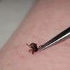 How to Remove Tick and Prevent Future Bites