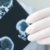 Reembolso por Servicios de Telesalud Ampliado para Cubrir la Epilepsia