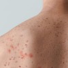 City Continues to Prioritize Those at Highest Risk of Monkeypox