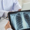 Nuevo Informe: Las Salvavidas Tasas de Detección del Cáncer de Pulmón son Demasiado Bajas en Illinois
