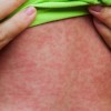 CDPH Investigating Measles at Pilsen New Arrivals Shelter