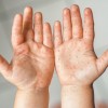 El Departamento de Salud de Cicero Advierte a los Residentes Sobre Posible Infección de Sarampión