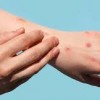 Actualización del Mpox en Chicago: Mejoran las Tasas de Contagio.