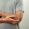 Chicago Mpox Update, Case Rates Improving
