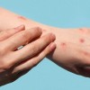 Chicago Department of Public Health Provides Update on Mpox Outbreak