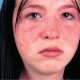 Free Educational Teleconference on Childhood Lupus