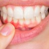 Gum Disease Causes Serious Issues