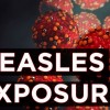 CDPH Investigating Measles Exposures in Chicago